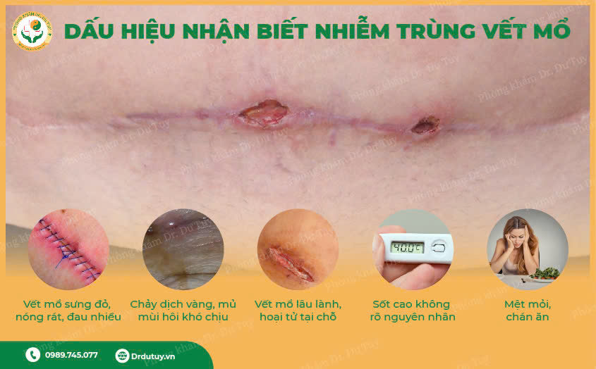 nhiem-trung-vet-mo (1)